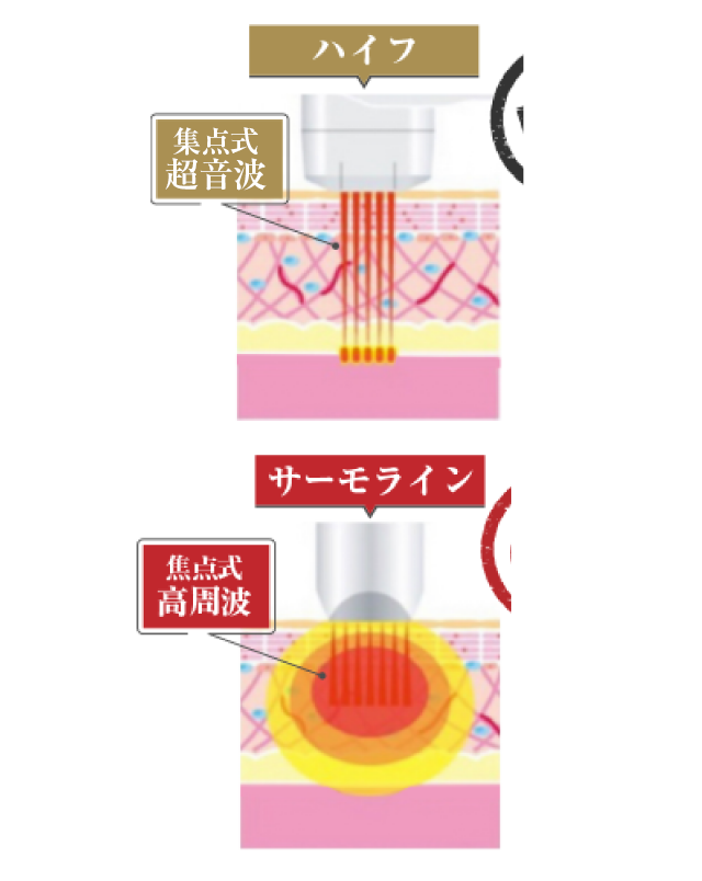 焦点式高周波